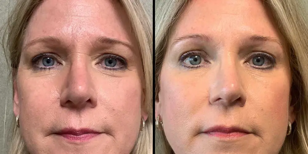 Side-by-side comparison of a woman's face before and after a cosmetic procedure, showing reduced wrinkles and smoother skin in the after image.