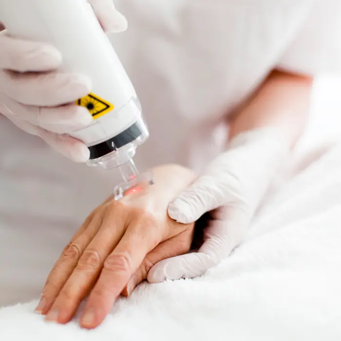 A medical professional uses a laser device on a patient's hand during a treatment, both wearing protective gloves.