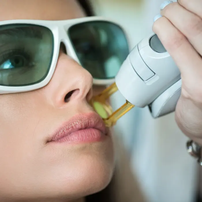 Person wearing protective goggles undergoing a laser treatment on the upper lip.